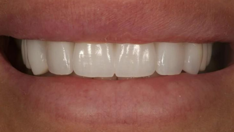 After treatment: Missing tooth replaced