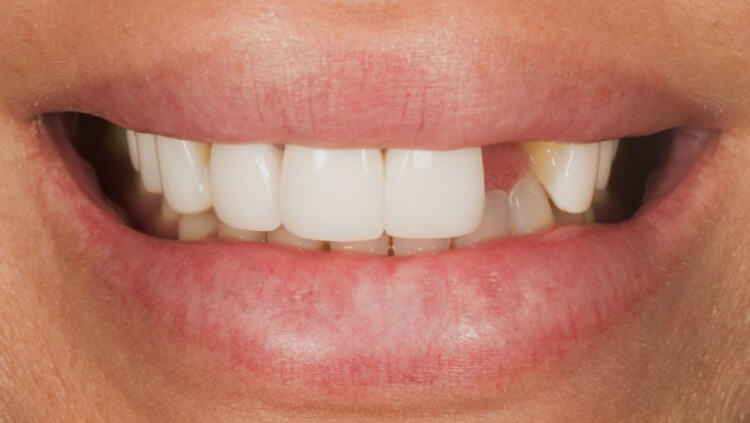 Before treatment: Missing tooth replaced
