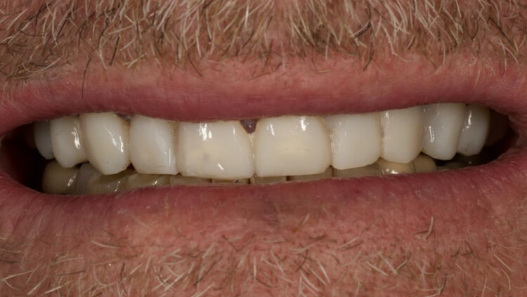 After treatment: Failing teeth replaced