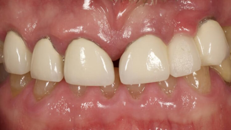 Before treatment: Failing teeth replaced
