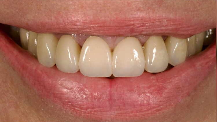 After treatment: Smile makeover