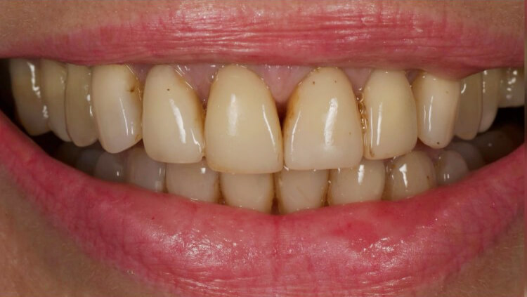 Before treatment: Smile makeover
