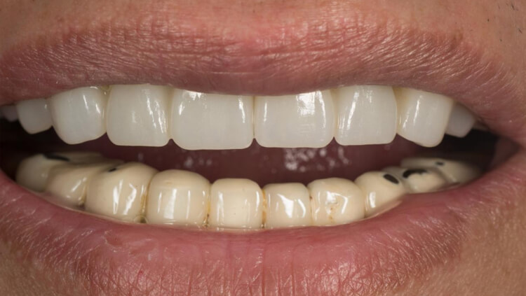 After treatment: Smile restoration