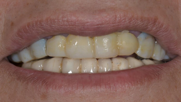Before treatment: Smile restoration