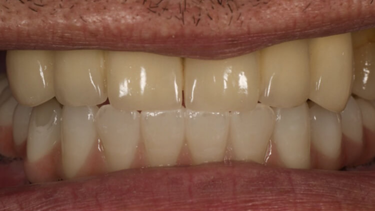 After treatment: Full-arch implants