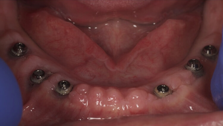 Before treatment: Full-arch implants